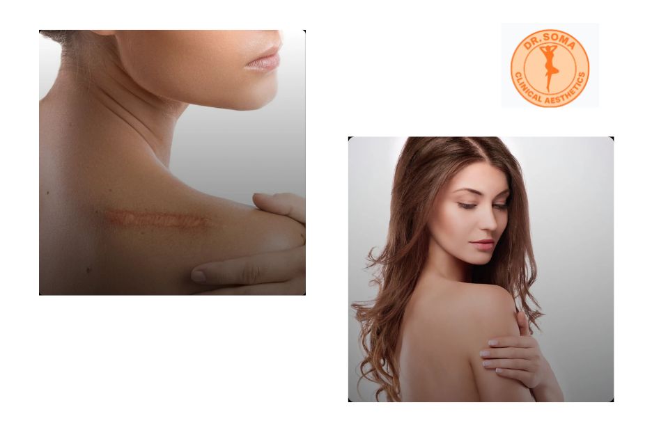 Understanding Breast Reduction and Lift Options in Malaysia Understanding Breast Reduction and Lift Options in Malaysia