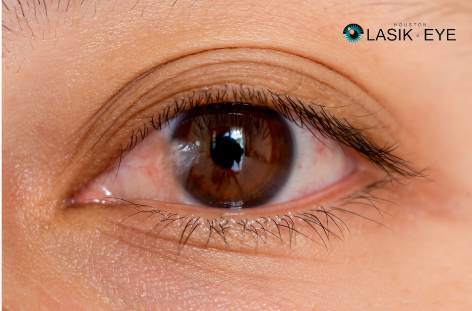Pterygium Surgery Recovery Guide: Tips for a Smooth and Fast Healing Process Pterygium Surgery Recovery Guide: Tips for a Smooth and Fast Healing Process