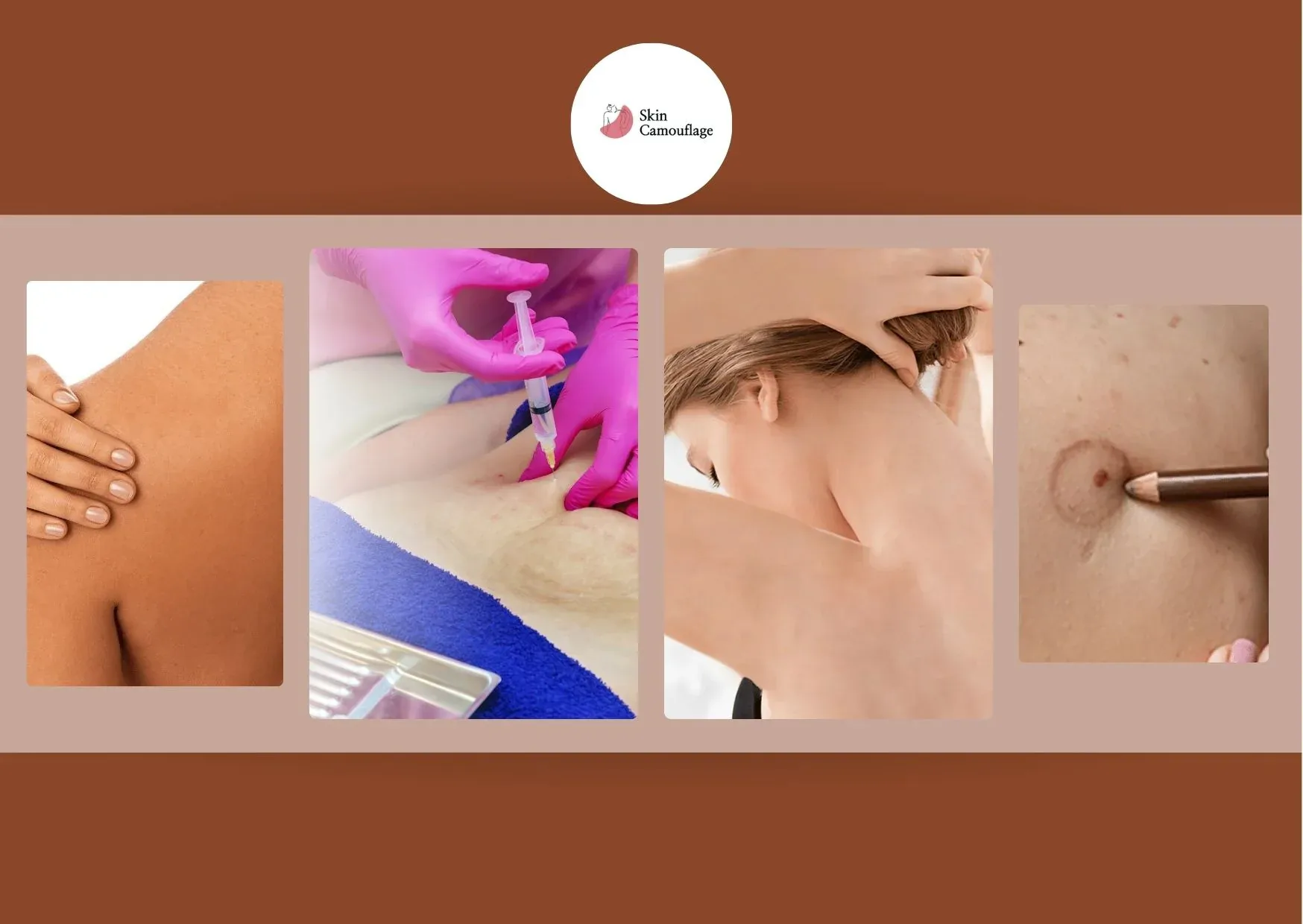 Effective Vitiligo Pigmentation Treatment in Dubai for Natural Skin Restoration Effective Vitiligo Pigmentation Treatment in Dubai for Natural Skin Restoration
